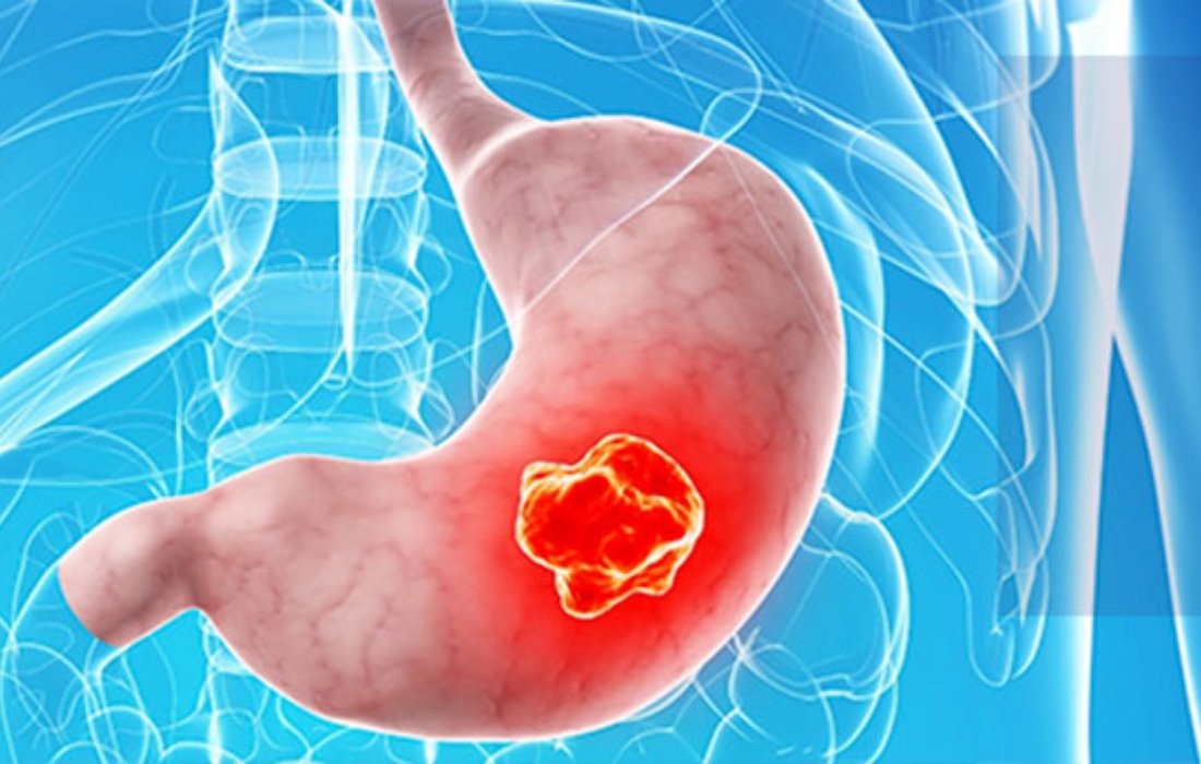 Investigan nuevo tratamiento para pacientes con cáncer gastroesofágico